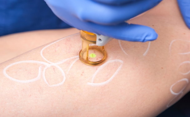 R20 Method of Laser Tattoo Removal