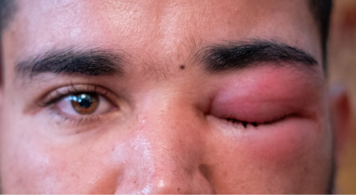 Man with swollen eyelid.