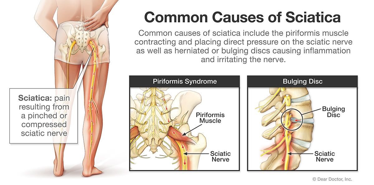 Common causes of sciatica.