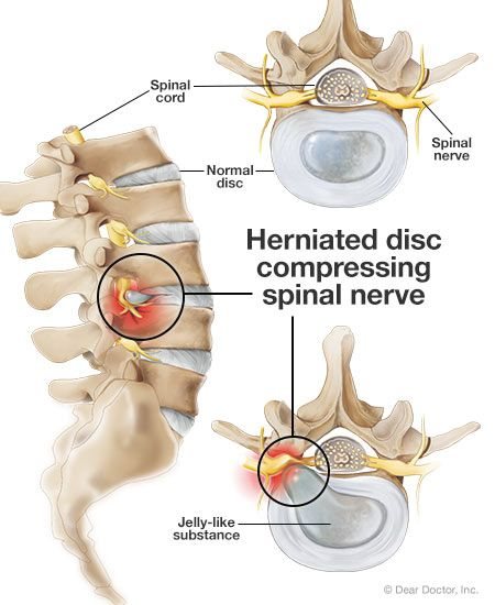 Herniated Disc