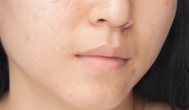 Acne Scars And Acne Scarring