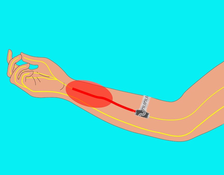 Graphic shows the stretchy pain relief strip working inside a patient's arm.