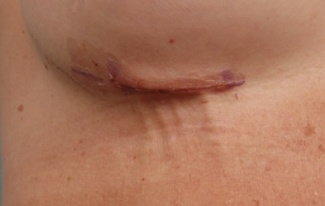 Mondor's cord, breast augmentation, breast implants