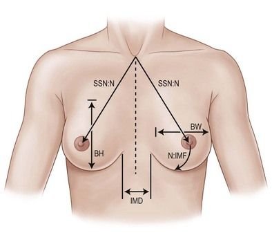 The Complete Guide to Breast Width Diameter and Implant Size