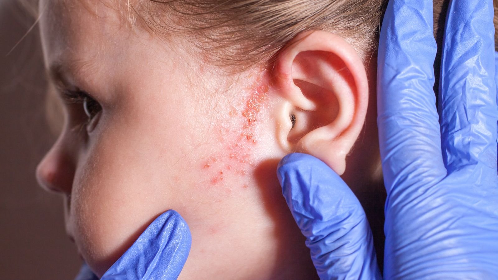 girl with rash near ear