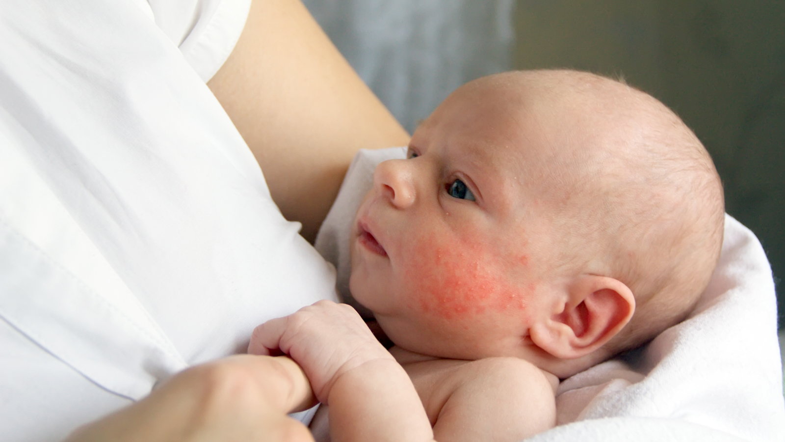 mom holding baby with a rash