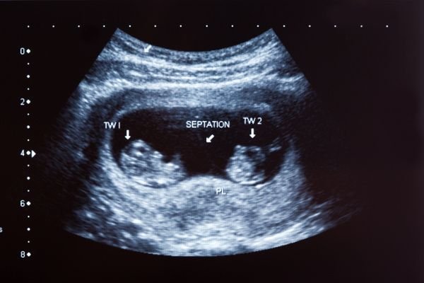 ultrasound of twins