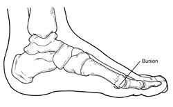 Bunion2 Bunion2