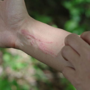 Contact Dermatitis