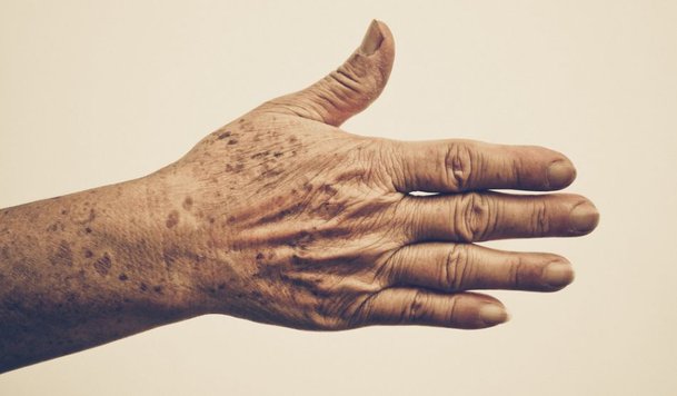 Symptoms of Liver Spots Symptoms of Liver Spots