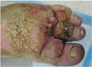 Patient with diseased foot and toes