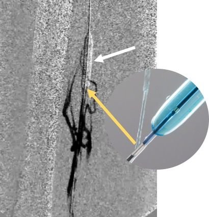 Figure 3. PTA of FPV with the Chameleon balloon (white arrow) and injection of t-PA/contrast via proximal infusion port (orange arrow). This allows prepping of the vessel and retrograde visualization of the distribution of t-PA into the diseases vessel minimizing systemic circulation