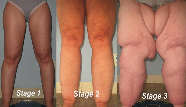Photos of patients with lipedema