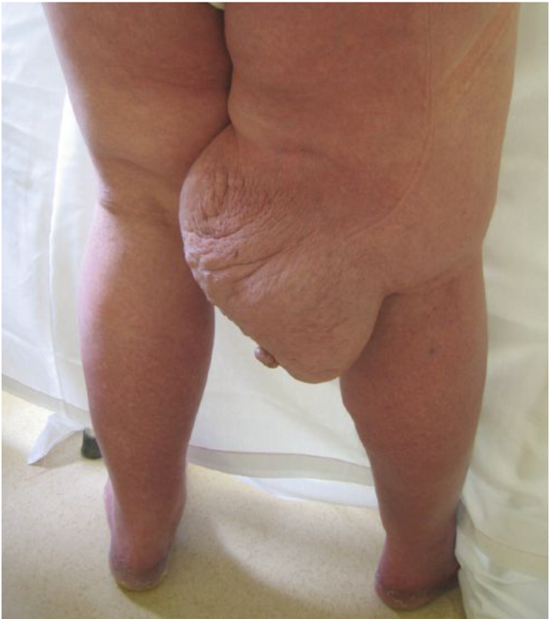 Patient with localized lymphedema