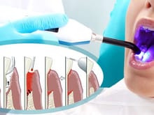 Laser Dentistry in Chandigarh