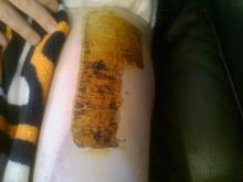 Skin Graft - January 2010