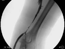 venous-fistulogram1.jpg