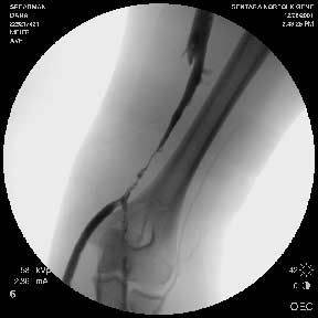 venous-fistulogram1.jpg