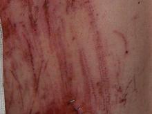 back staples